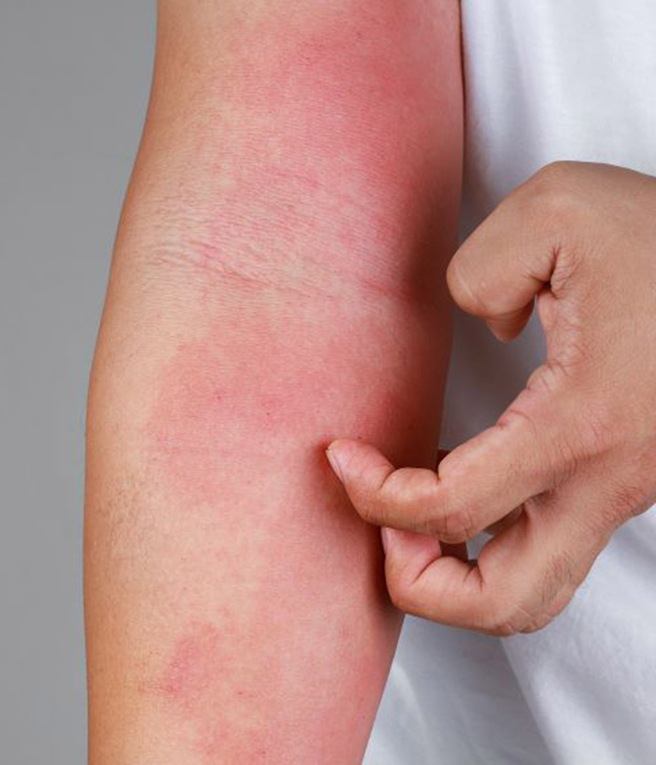 Eczema